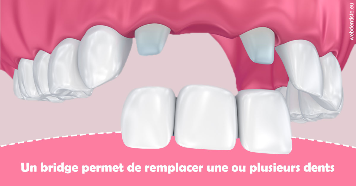 https://selarl-dentech.chirurgiens-dentistes.fr/Bridge remplacer dents 2