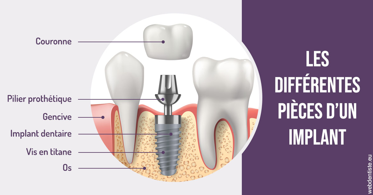 https://selarl-dentech.chirurgiens-dentistes.fr/Les différentes pièces d’un implant 2
